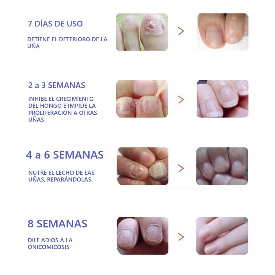 16 Parches para Hongos en Uñas